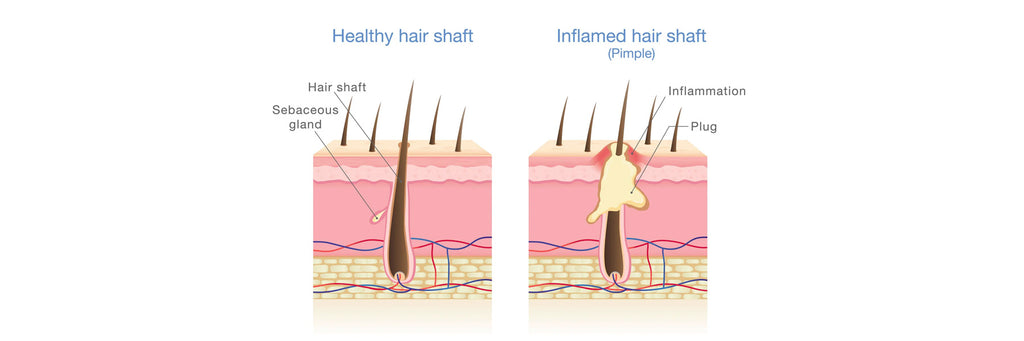 7 Steps Guaranteed To Clear A Fungal Infection of the Scalp