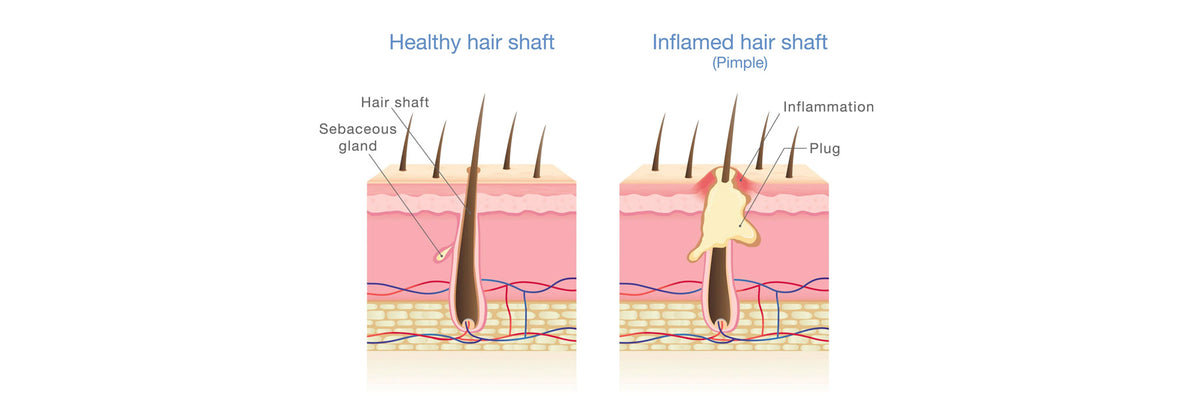 7 Steps Guaranteed To Clear A Fungal Infection of the Scalp – Morrocco ...